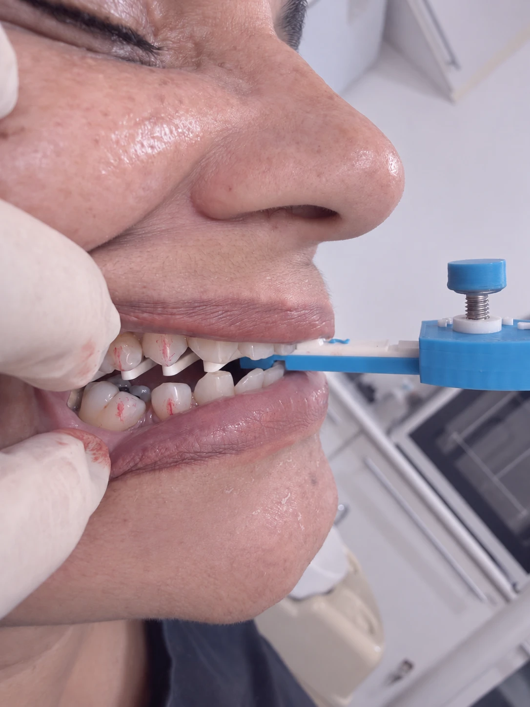 Registro de mordida com dispositivo de avanço mandibular